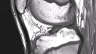 OsgoodSchlatter Disease [upl. by Alig]