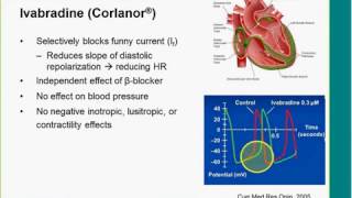 New Options for Advanced Heart Failure Drugs and Devices by Michael Zacharias DO [upl. by Aniahs346]