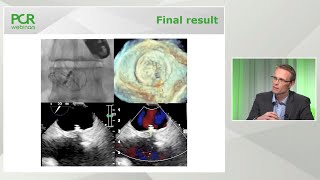 PFO closure in 2019 – Who Why and How  PCR Webinar Round Table [upl. by Tlok]