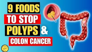 Colon Polyps and Stop Bowel 9 Foods to Fight Cancer Naturally Vitalhealth6 [upl. by Seaden]