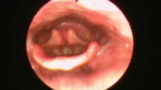 Fiberoptic Endoscopic Evaluation of Swallowing FFES example [upl. by Payton]