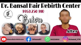 Alopecia Treatment Patients Success Story with Dr BANSAL [upl. by Xonel]