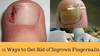 11 Ways to Get Rid of Ingrown Fingernails [upl. by Lyrrehs]