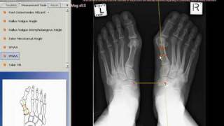 TraumaCad  Proximal Metatarsal Articular Angle [upl. by Kenaz]