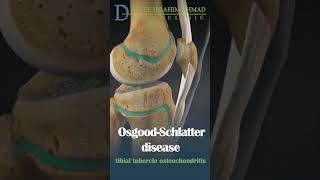 what is osgood schlatter disease [upl. by Roots446]