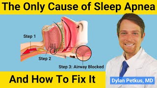 Why Obstructive Sleep Apnea Only Has One Cause and How to Fix It [upl. by Nnazil]