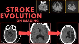 Stroke Evolution on CT and MRI Imaging [upl. by Golliner]