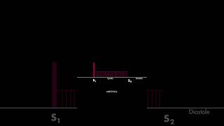 Holosystolic murmur [upl. by Llenehc922]