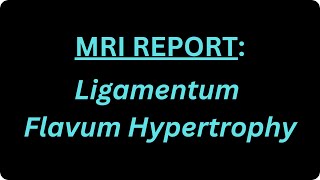 What is Ligamentum Flavum Hypertrophy [upl. by Eitsrik]