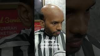 Baldness solved in 2hrs hairpatchesformen hairreplacementsystems hairhairbonding hairclip [upl. by Nabroc]