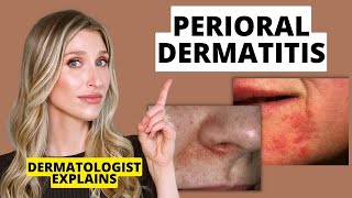 Dermatologist Explains Perioral Dermatitis What it Looks Like Causes amp Treatments  Dr Sam Ellis [upl. by Caro]