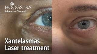 Xantelasmas  Laser treatment  23269 [upl. by Dlabihcra]