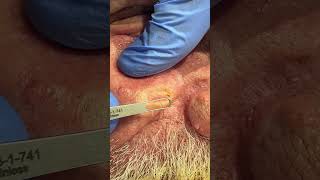 Satisfying Blackhead Popping  Dr Derm [upl. by Ihsar]