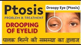 Droopy Eyelid Treatment  Ptosis Treatment with top Oculoplastic surgeon पलक गिरने की समस्या का इलाज [upl. by Sitnerp]