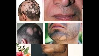 Skin DiseaseAlopecia Areata ઉંદરી [upl. by Giddings]