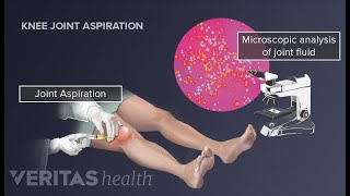 Arthrocentesis and Synovial fluid Analysis to Diagnose musculoskeletal system diseases [upl. by Hagan]