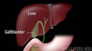 Gallstones and Surgical Removal of Gallbladder Cholecystectomy Animation [upl. by Rbma]