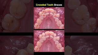 Complex braces for crowded teeth braces orthodontist dentist [upl. by Anrim]