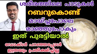 ശരീരത്തിലെ പാടുകൾ റബ്ബറുകൊണ്ട് മായ്ച്ചപോലെ മാഞ്ഞുപോകും ഇത് പുരട്ടിയാൽ  How to remove stretchmarks [upl. by Ainuj]