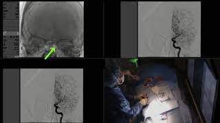 Mechanical Thrombectomy for Acute Stroke [upl. by Airitak693]