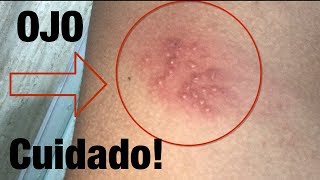 Herpes zoster Sintomas Culebrilla en jovenes [upl. by Verdie]