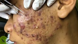 Blackhead Removal  Acne Cystic Treatment  Facial Spa Pimple Popping  Elderly Hidden Acne  076 [upl. by Urbas]