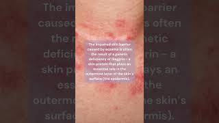 What is Eczema Atopic Dermatitis  Skin Type Solutions [upl. by Martella]