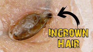 Ingrown Hair Removal x Satisfying Blackheads [upl. by Genni]