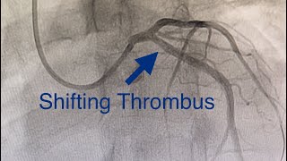 Thrombus Shifts to LCX Acute Anterior MI Cardiogenic Shock Ostial LAD Occlusion How To Treat [upl. by Enej]