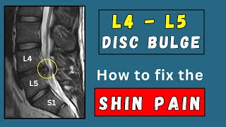 How to fix Shin pain due to lumbar L4  L5 disc bulges [upl. by Mathur]