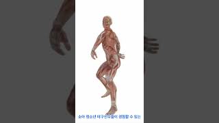 팔꿈치 관절  청소년 박리성 골연골염의 이해 Elbow Joints Understanding Osteochondritis Dissecans in Adolescents [upl. by Yenoh123]