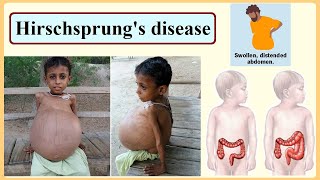 Hirschsprungs disease [upl. by Ykceb]