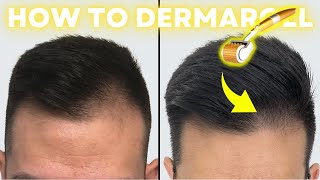 How to Derma Roll for Quickest Hair Results StepbyStep Guide [upl. by Yesnil435]