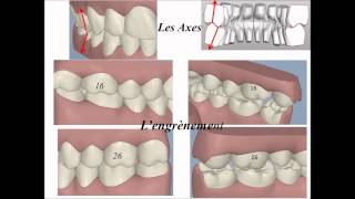 Ortho4 Analyse occlusale informatique et articulateur [upl. by Kiona135]