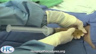 Paracentesis Procedure Video Trailer [upl. by Drarehs]