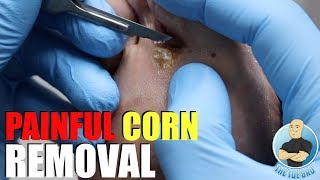 SUPER PAINFUL CORN REMOVAL [upl. by Aland]