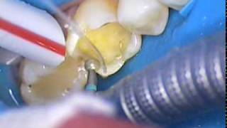 DR GERARD CUOMO  Replacing old dental fillings with cosmetic crowns 1 of 4 Boca Raton Florida [upl. by Marj]