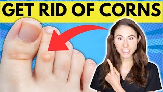 How To Get Rid Of Corns On The Feet [upl. by Aniles]