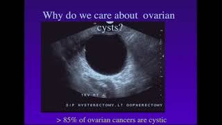 Screening of Ovarian Cancer [upl. by Adihsaar778]