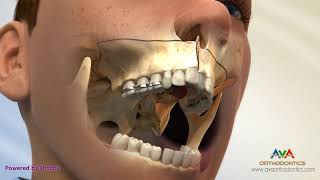 Surgical Orthodontic Treatment for Constricted Upper Jaw  SARPE [upl. by Geller]