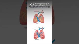 All About Pulmonary Arterial Hypertension Symptoms and Detection  Gleneagles Hospital [upl. by Alhan]