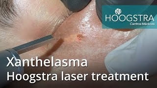 Xanthelasma  Hoogstra laser treatment 22082 [upl. by Noillimaxam345]