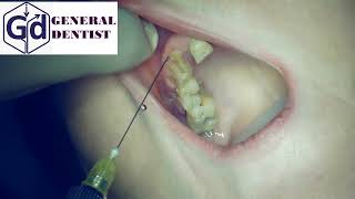 Infiltration anesthesia for extraction 12 tooth [upl. by Kala]