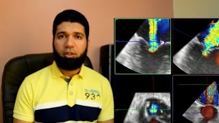 How to measure the 3DVena Contracta Area 3DVCA for mitral regurgitation [upl. by Relda]