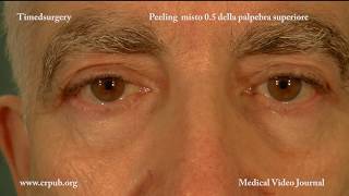 12Blefaroplastica non chirurgica con il peeling misto 05 [upl. by Uphemia16]