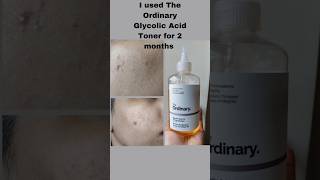 I tested The Ordinary  Glycolic Acid Toner for 2 months😳 makeup skincare ytshorts trending [upl. by Sarkaria]