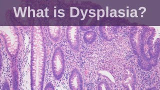 What is Dysplasia  Pathology mini tutorial [upl. by Tahp]