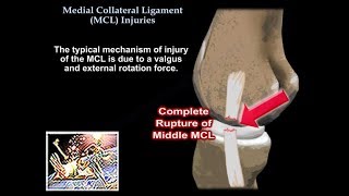 Medial Collateral Ligament Injuries  Everything You Need To Know  Dr Nabil Ebraheim [upl. by Marrilee92]