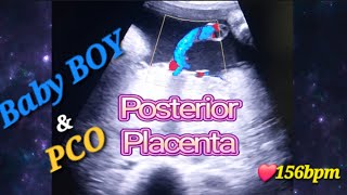 Genderreveal with Baby Movements Why amp When  Posterior Placenta with baby💙  PCO  Polycystic ovary [upl. by Esenej57]