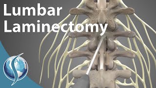 Lumbar Laminectomy [upl. by Leumek]